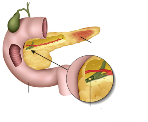pancreatitis is inflammation of the pancreas
